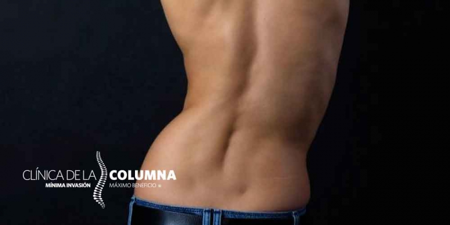 ¿Qué es la escoliosis?
