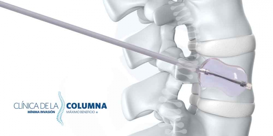 Cifoplastia con globo