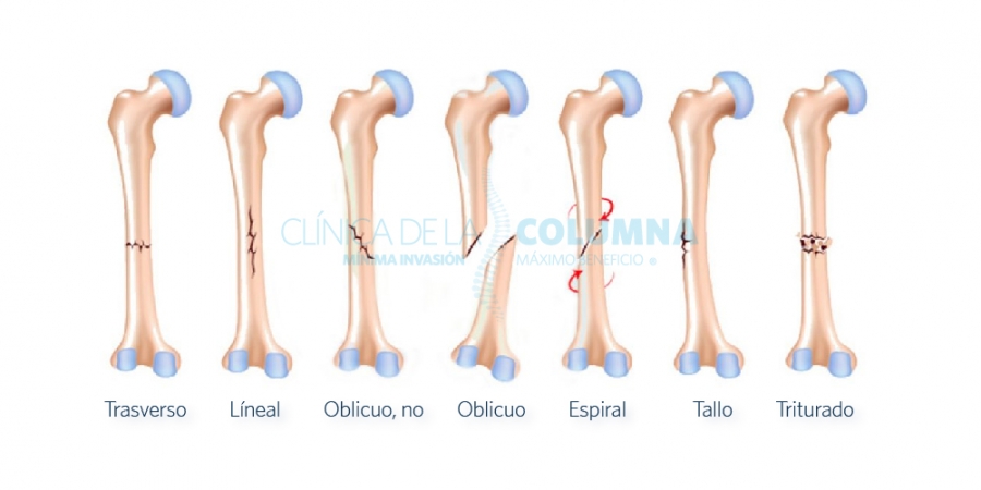 Tipos de Fracturas Óseas